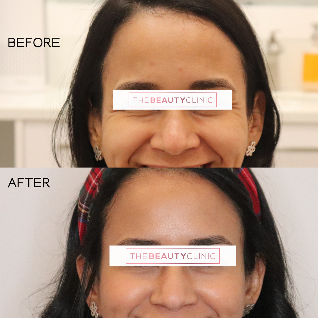 The Beauty Clinic - Toxins - Before and After