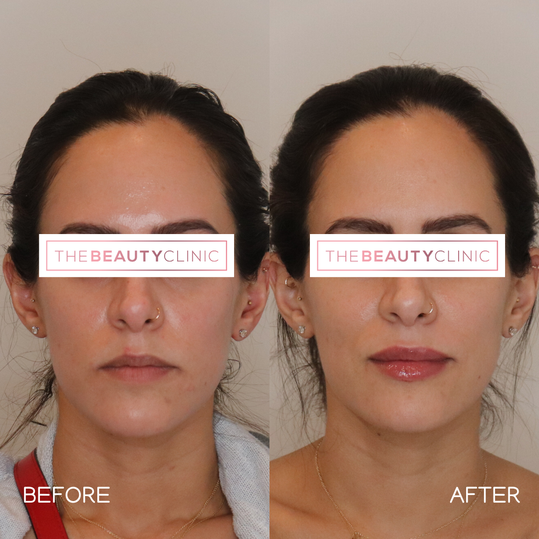 Lip Filler - Before and After - The Beauty Clinic