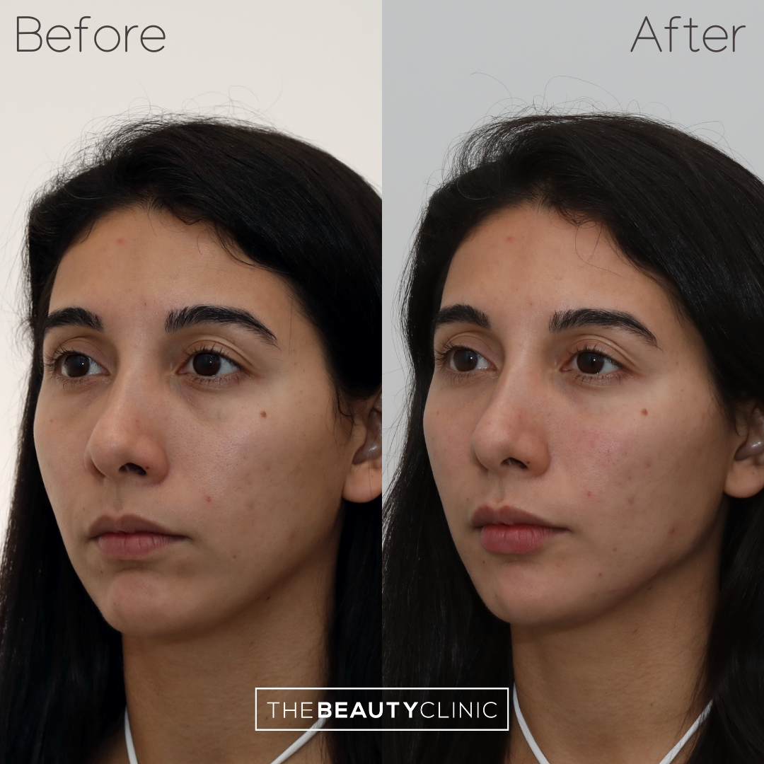 The beauty clinic - Facial Balancing with Filler - Before and after - filler