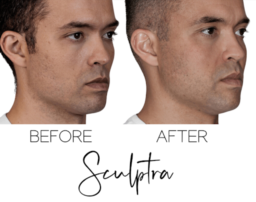 Sculptra - Before and After - The Beauty Clinic