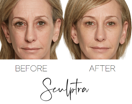 Sculptra - Before and After - The Beauty Clinic