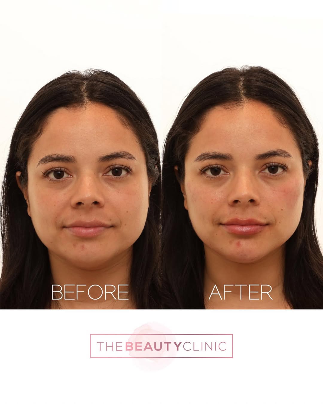 The Beauty Clinic Filler Before and After