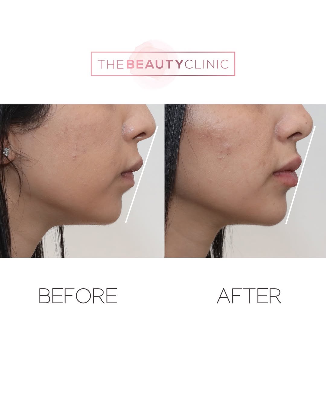 Seeking facial harmony? Achieving the perfect balance between your nose, lips, and chin is key. When filler is added in the right spots, your features align beautifully, creating a look your eyes will love. Discover the art of facial harmony. Call us for your consultation: 305-882-9439.