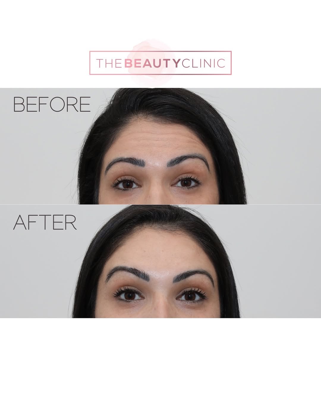 Worried about losing expression after Botox? Rest assured, you can still lift your eyebrows and keep your natural look. Botox can effectively prevent forehead lines while preserving your ability to express. Don’t be afraid of Botox - you can have smooth, youthful skin without the frozen feel. There’s a reason we’re top 1% for toxin in the country. Book your consultation today: 305-882-9439.