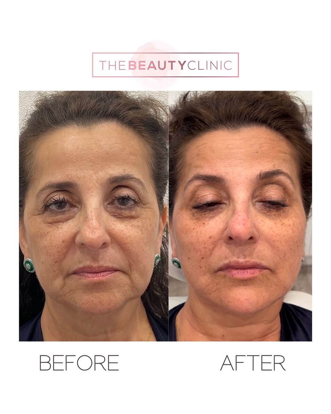Lately, we’ve been hearing from many patients that they’re afraid of filler. And we’re happy to hear it because filler is misused every day. It’s much harder for us to fix bad filler than to start from a clean slate. A small amount of filler placed in the wrong place ➡️ UNNATURAL, EYE-CATCHING result. Several syringes of properly selected filler placed in the right places ➡️ NATURAL, SEAMLESS results. To look like you, but better, you need an expert. Call us for your consultation: 305-882-9439