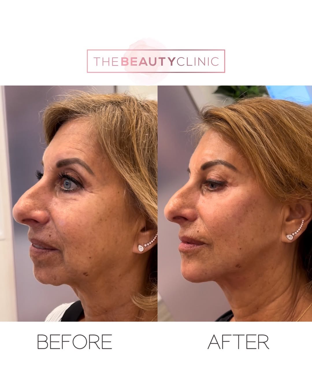 What can 9 syringes of filler do? 🪄 Straighter jawline 🪄 Defined lips 🪄 Lifted cheeks If you saw only the “after” photo, would you suspect she had filler?