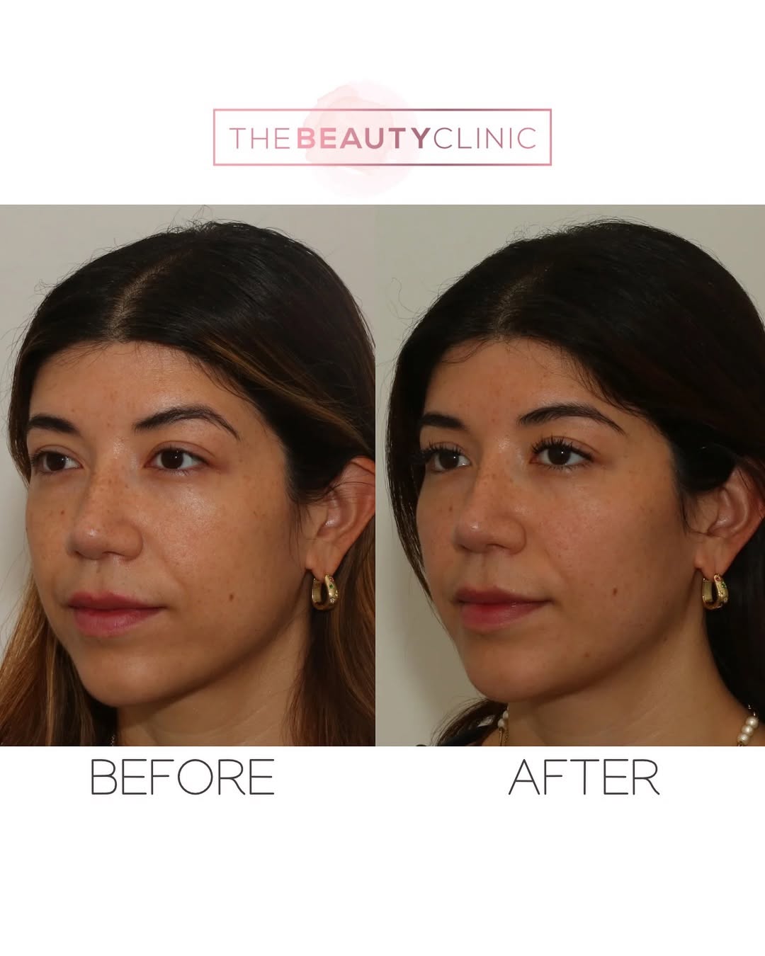 hey’re not looking for overdone results. They have done the research and selected an injector who can enhance without overdoing. This beauty trusted us to place filler in her cheeks, undereyes, and chin shadows, producing an airbrushed, refreshed look. Don’t trust just anyone with your face. Call 305-882-9439 for your complimentary assessment ✏️✨