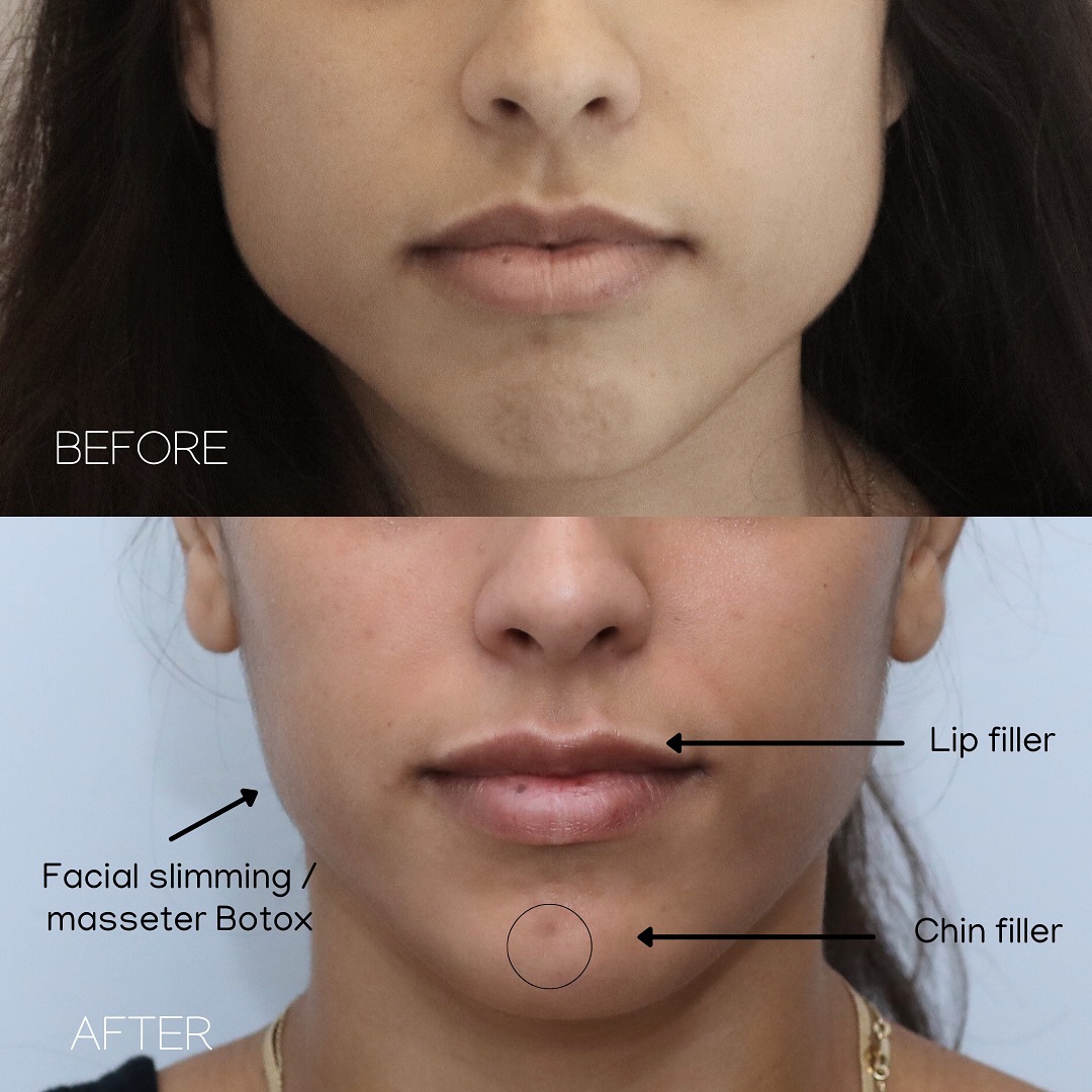 Facial balancing and harmonization achieved! 📐 Using filler and Toxin, we refined facial angles for a naturally enhanced look. What catches your eye first? 💉 Slimmer, more defined face shape 💉 Enhanced chin contours 💉 Sharper, more sculpted jawline 💉 Perfectly balanced upper and lower lips Ready to bring out your best angles? Book your consultation today! 305-882-9439