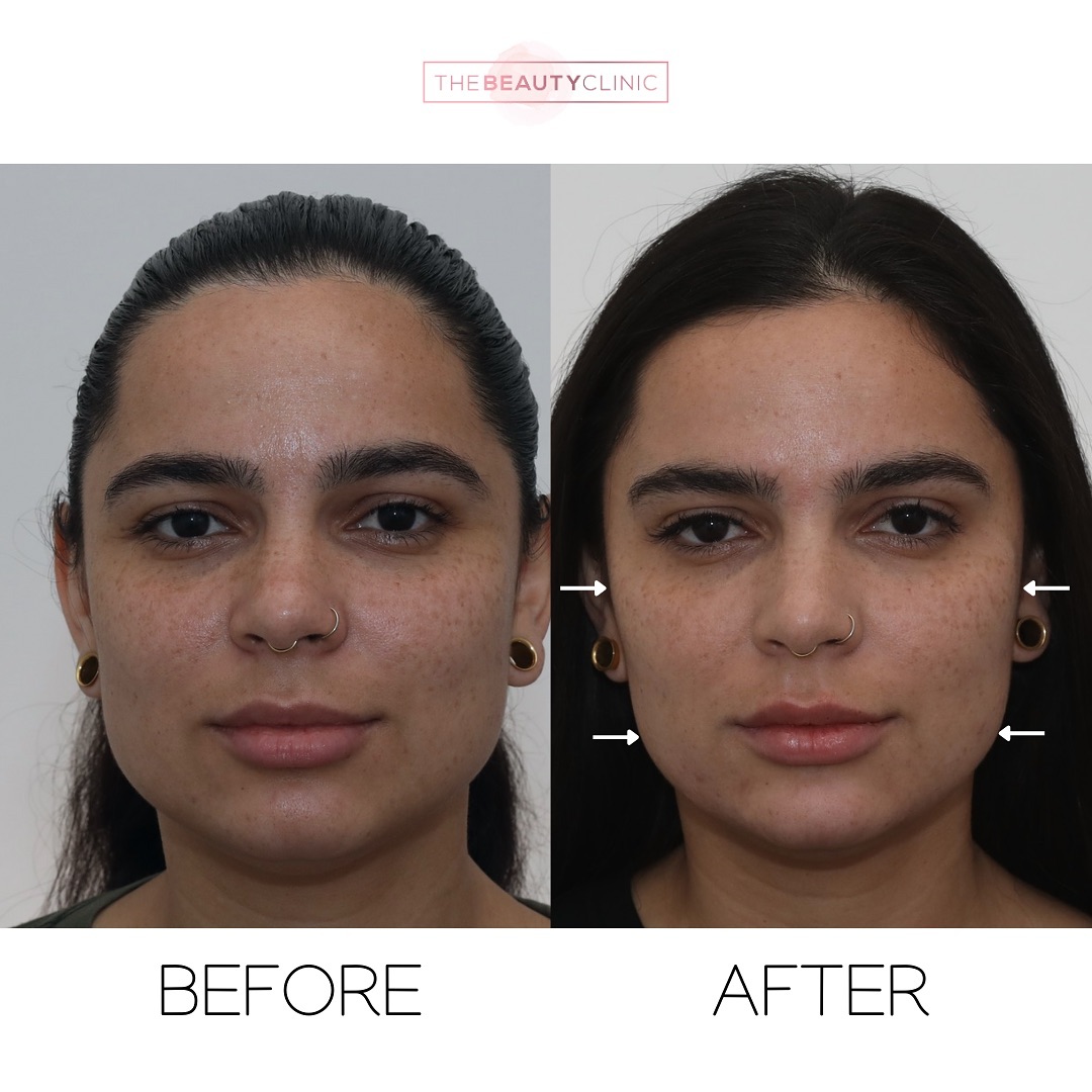 What if one treatment could slim your face and ease headaches? We started this beauty’s journey with Botox in her jawline, helping to slim her face over 3-4 weeks while easing clenching, grinding, and headaches—total game-changer! Once her jawline softened, we enhanced her natural beauty with filler to define her cheekbones, chin, and lips. The result? A delicate, refined look that’s still 100% her. Call us at 305-882-9439 or book your consultation today to enhance your natural beauty with treatments tailored just for you.