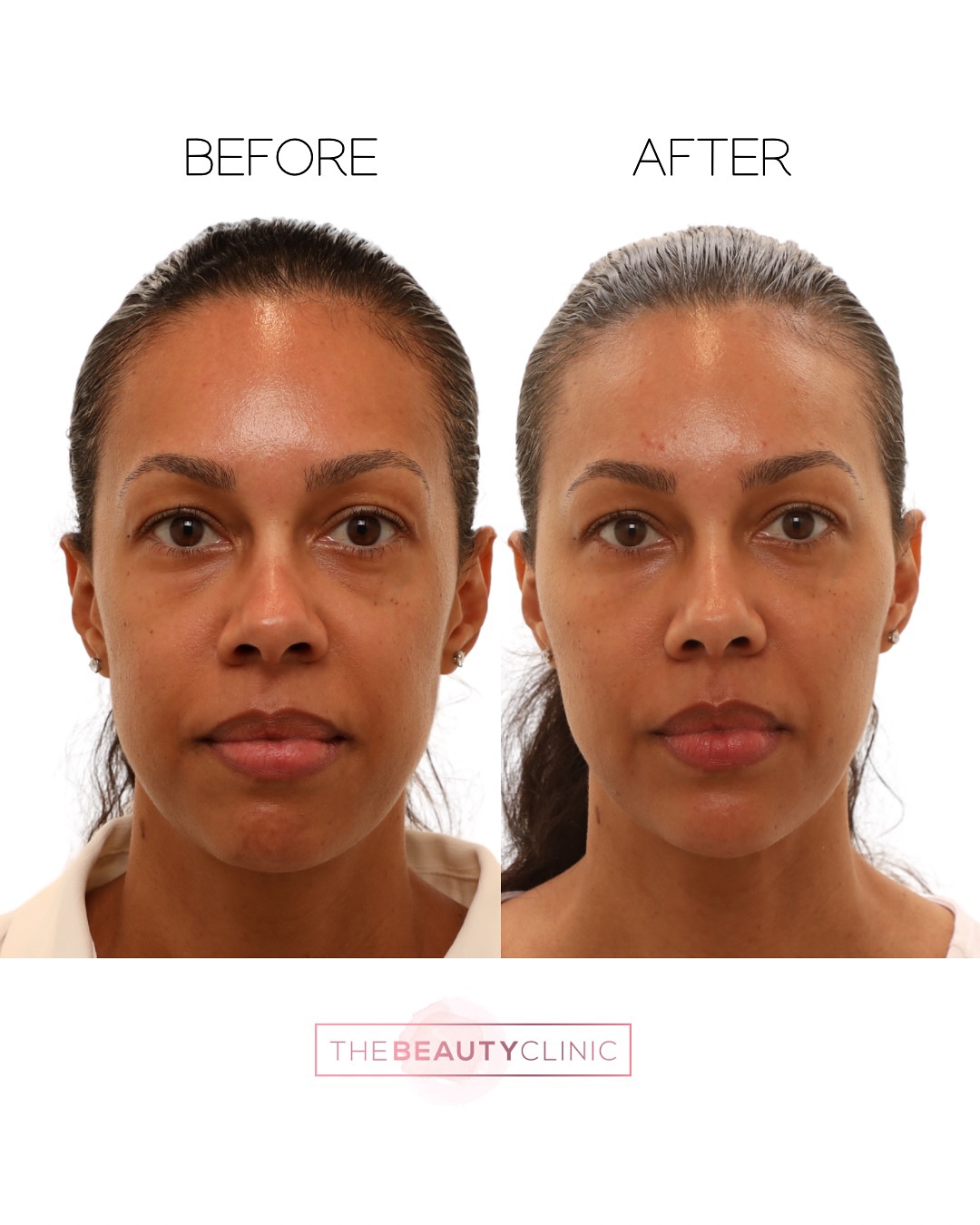 She’s glowing after visiting The Beauty Clinic—but you can’t quite put your finger on it. With an artistic touch of tox, filler, Sculptra, and EZ Gel, her true beauty shines through. You’d never guess she was injected. Ready for your glow-up? Call / text 305-882-9439