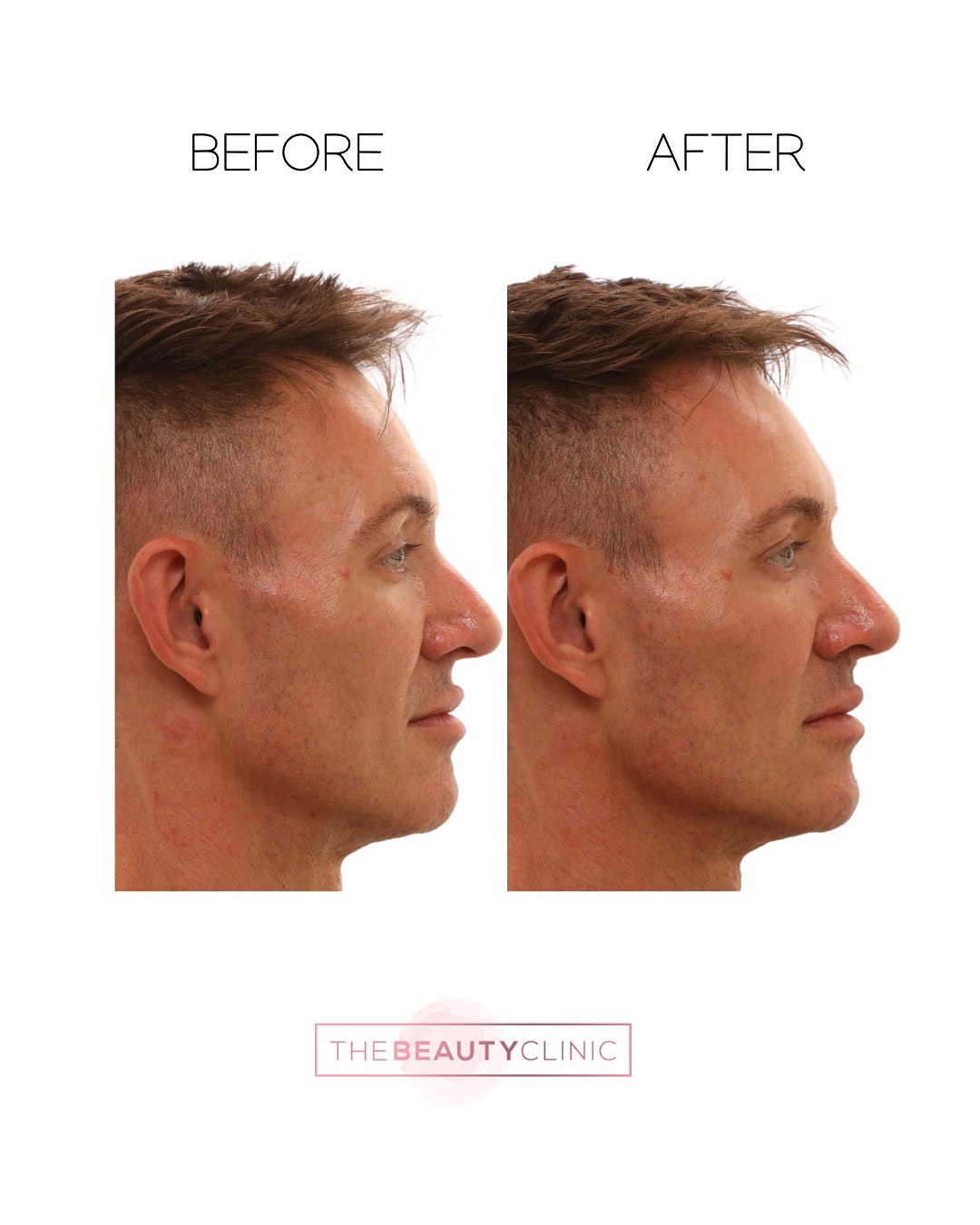 Men should not look “injected” either. It takes even MORE skill to keep a man looking natural. Using filler, we amplified his natural masculine features by strategically placing filler in the chin, jawline, frame of face, and nose. Male faces are treated completely differently from female. Carelessly placed filler can unintentionally feminize a man (the opposite of the intended effect here.) Since there was no specialized training on men in the US, we flew all the way to England in 2022 to learn masculinization. Men: we can help you look stronger, manlier, and more handsome. We offer discreet consultations 305-882-9439